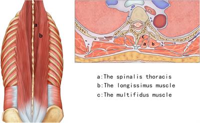 The feasibility and efficacy of pedicle fixation by the Wiltse approach in the thoracic spine